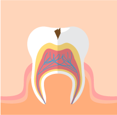 虫歯②