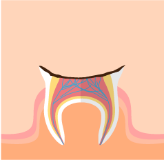 虫歯④